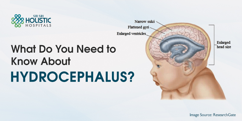 What Do You Need to Know About Hydrocephalus?