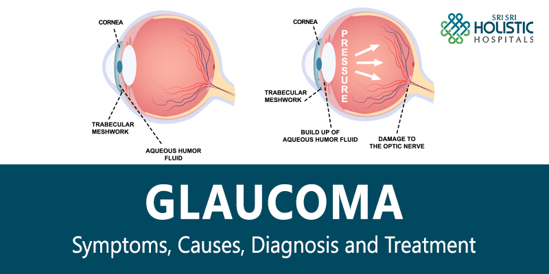 Glaucoma – Symptoms, Causes, Diagnosis and Treatment