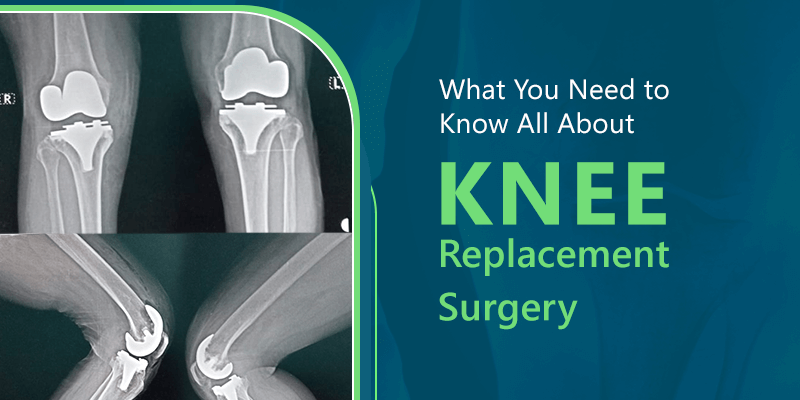 What You Need to Know All About Knee Replacement Surgery