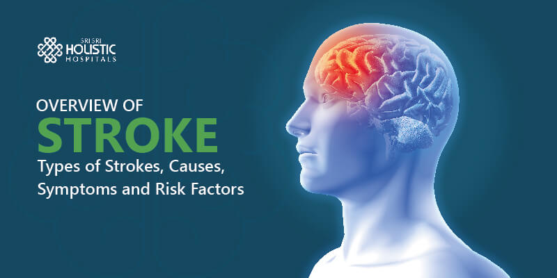 Overview of Stroke: Types of Strokes, Causes, Symptoms and Risk Factors