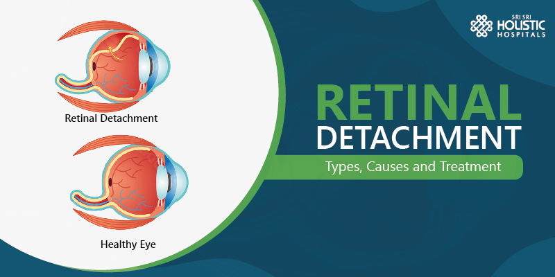 An Overview on Retinal Detachment – Types, Causes and Treatment