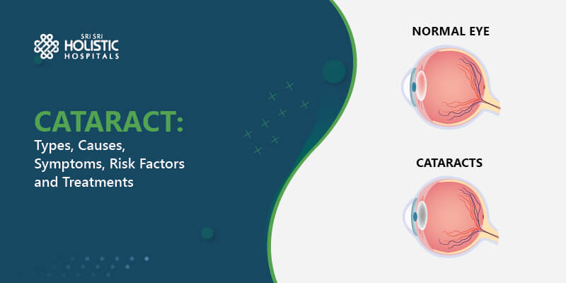 What Are Cataracts: Types, Causes, Symptoms, Risk Factors and Treatments