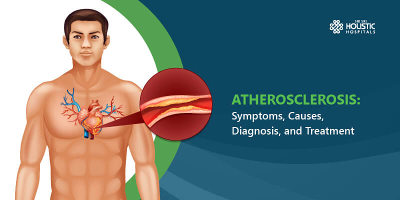Atherosclerosis: Symptoms, Causes, Diagnosis, and Treatment
