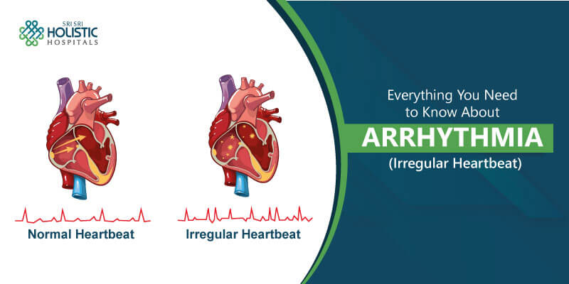 Everything You Need to Know About Arrhythmia (Irregular Heartbeat)