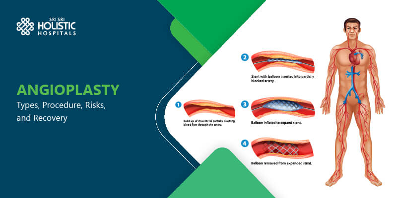 Angioplasty: Types, Procedure, Risks, and Recovery