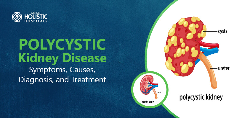 Polycystic Kidney Disease – Symptoms, Causes, Diagnosis, and Treatment