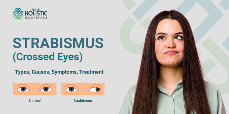 Strabismus(Crossed Eyes) – Types, Causes, Symptoms, Treatment