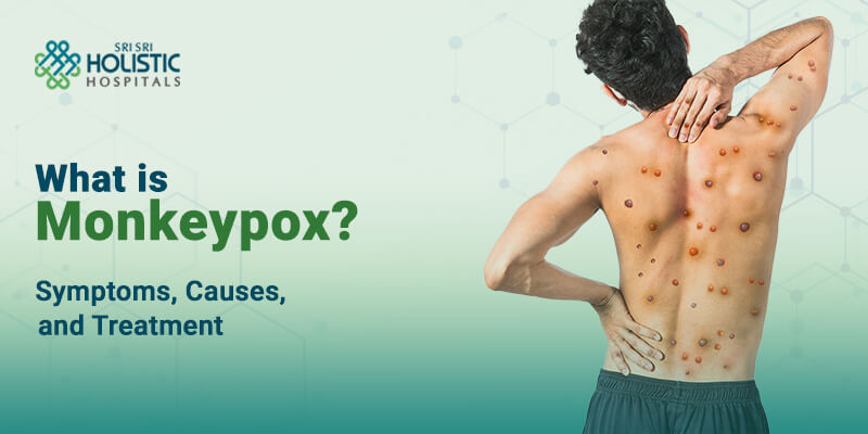 What is Monkeypox | Symptoms, Causes, and Treatment