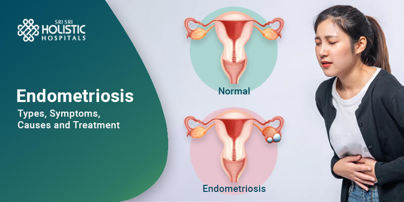 Endometriosis – Types, Symptoms, Causes, and Treatment