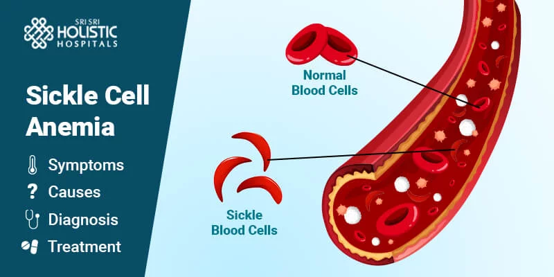 Sickle Cell Anemia- Symptoms, Causes, Diagnosis, and Treatment