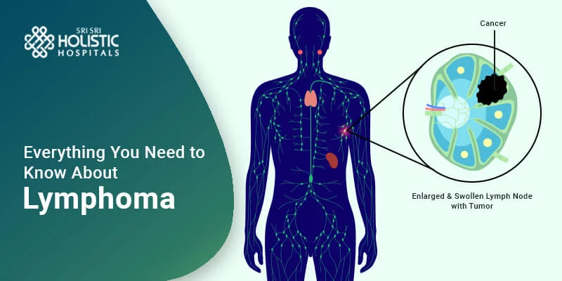 Everything You Need to Know About Lymphoma